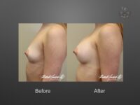 breast augmentation before and after
