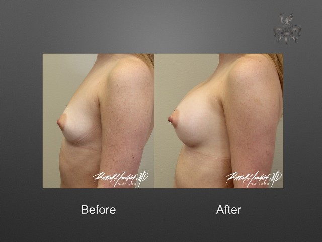 breast augmentation before and after