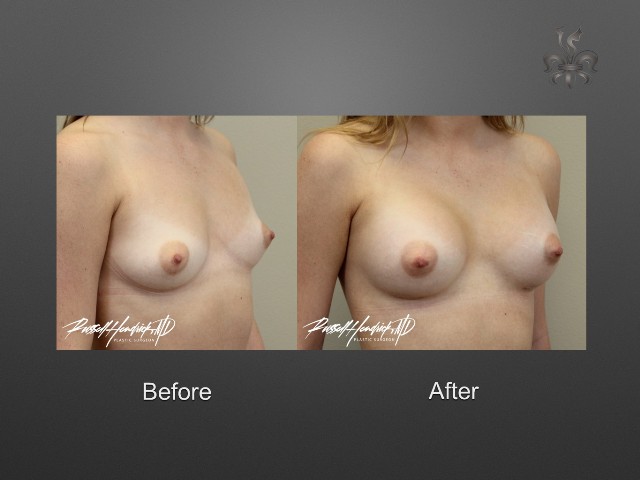 breast augmentation before and after