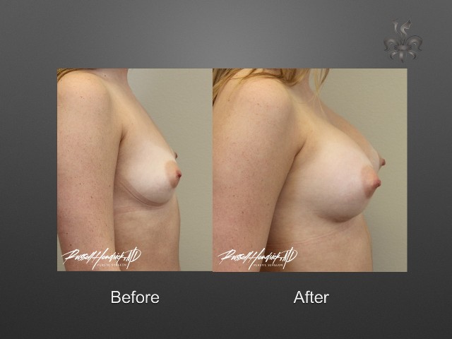 breast augmentation before and after