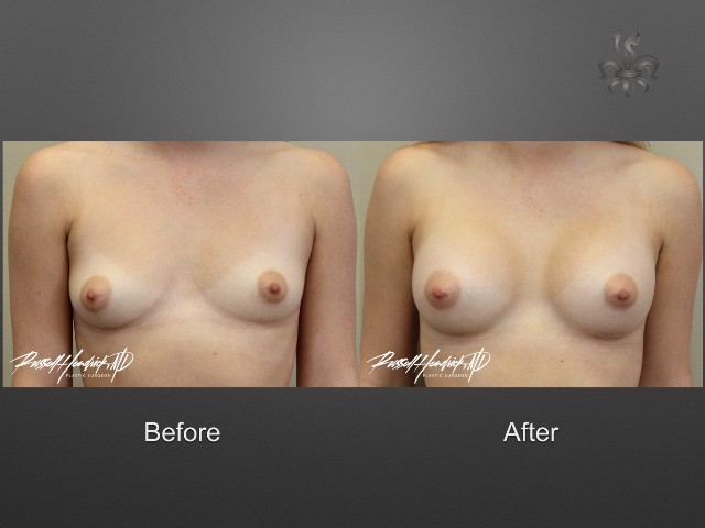 breast augmentation before and after
