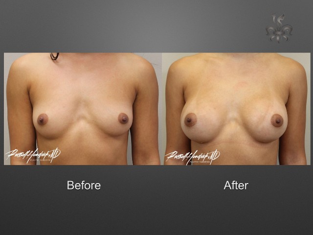 breast lift before and after