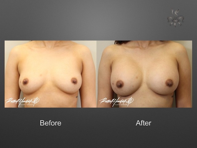 breast lift before and after