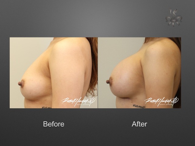 breast augmentation before and after