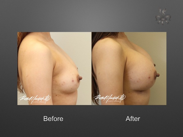 breast lift before and after