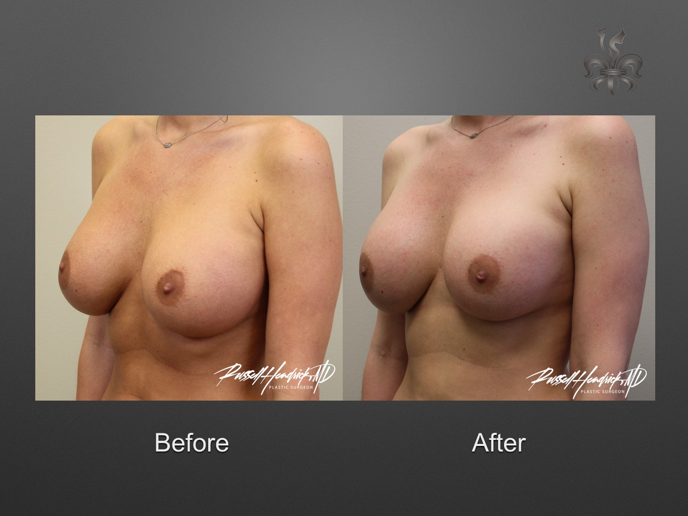 breast implant revision before and after