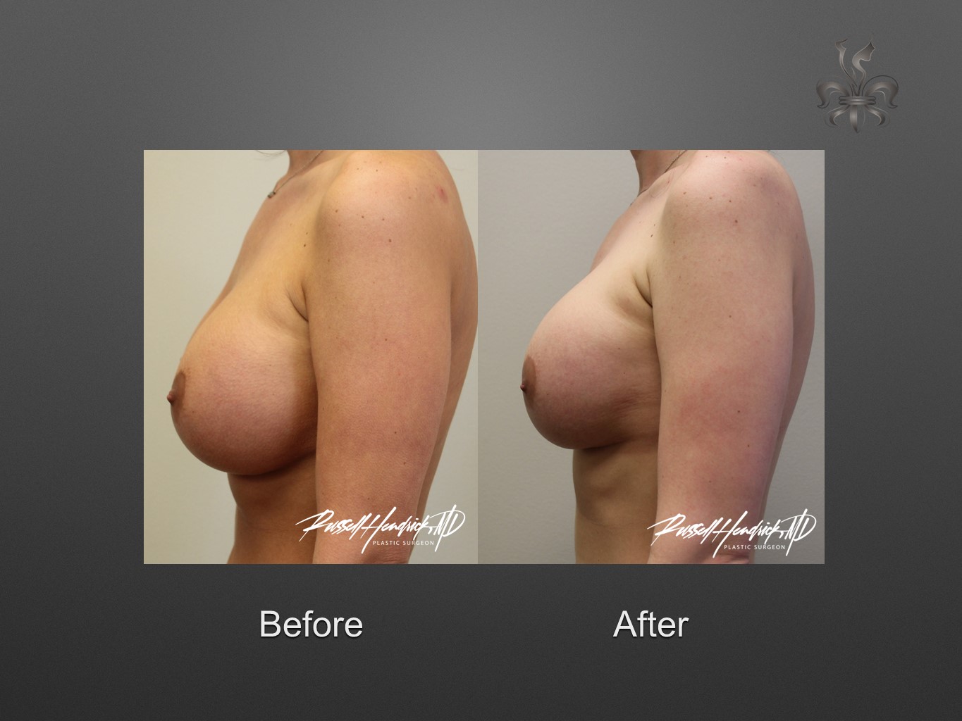 breast implant revision before and after