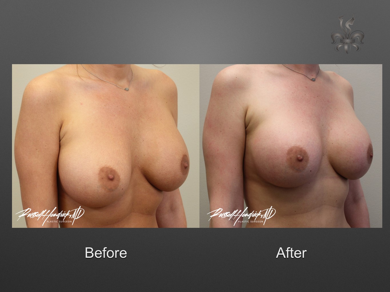 breast implant revision before and after