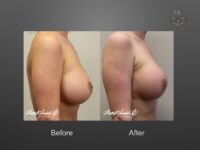 breast implant revision before and after