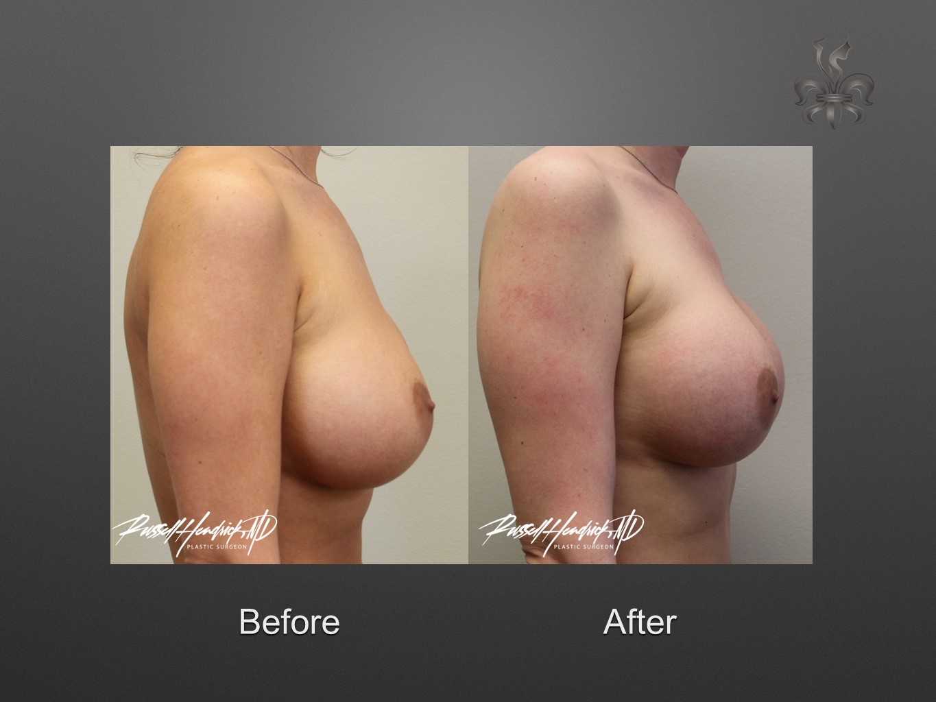 breast implant revision before and after