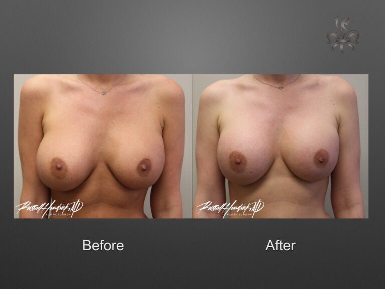 breast implant revision before and after