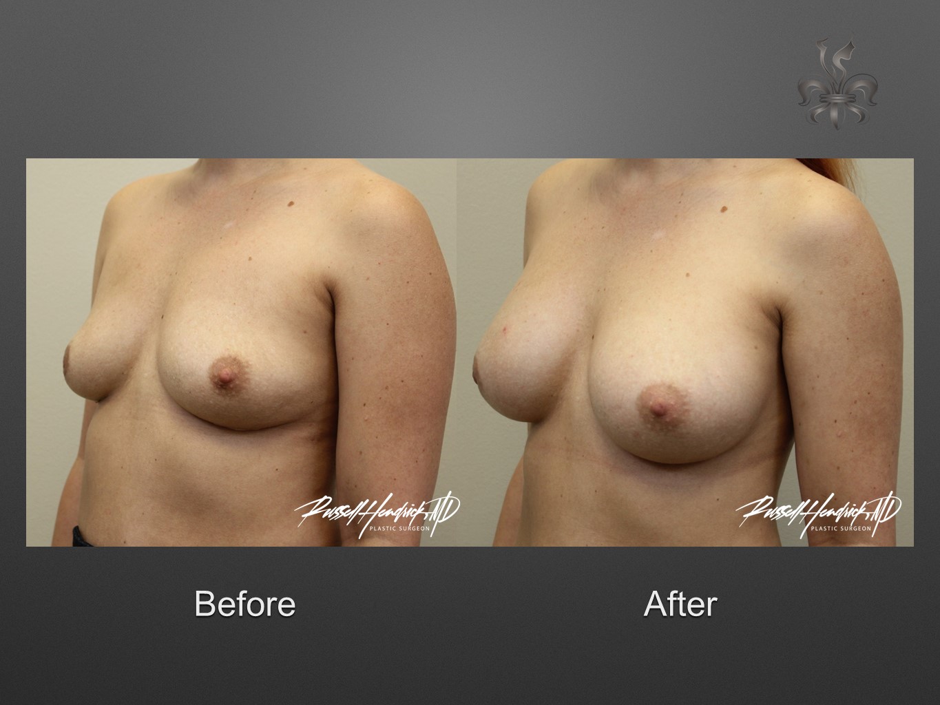 breast implant revision before and after