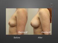 breast implant revision before and after