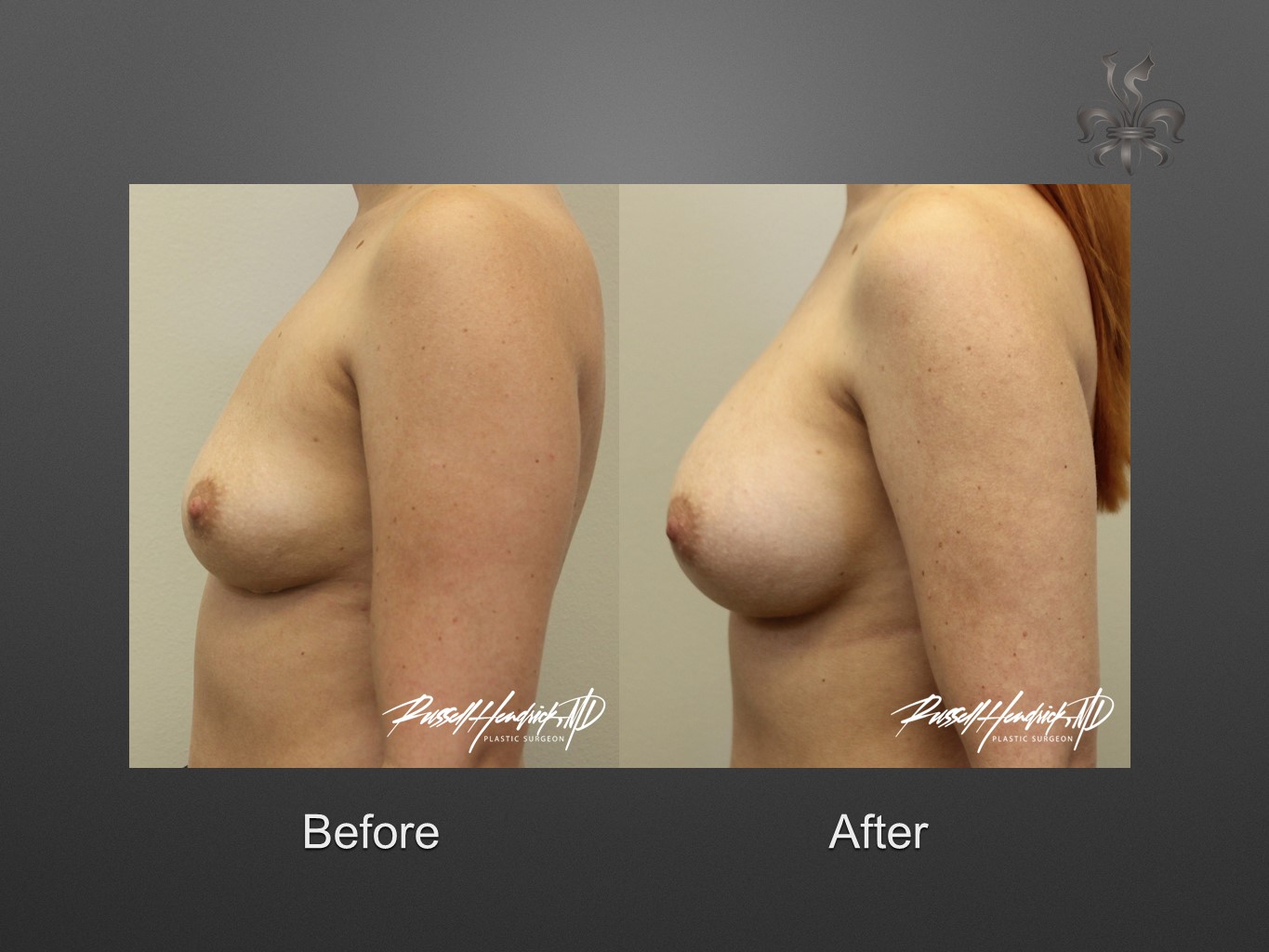 breast implant revision before and after