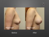 breast implant revision before and after