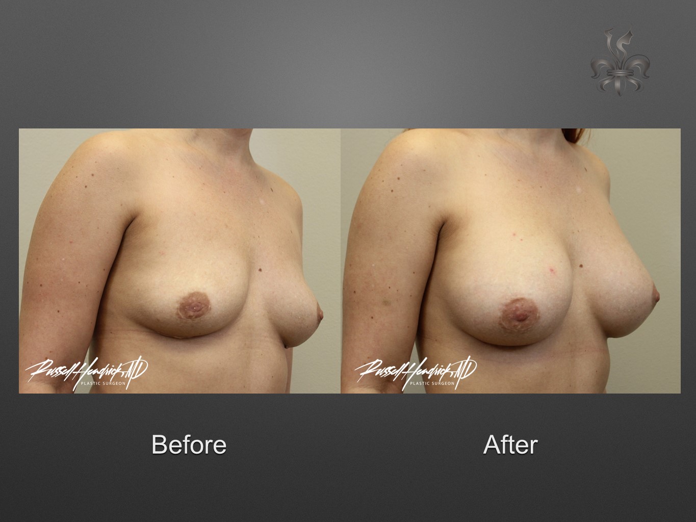 breast implant revision before and after