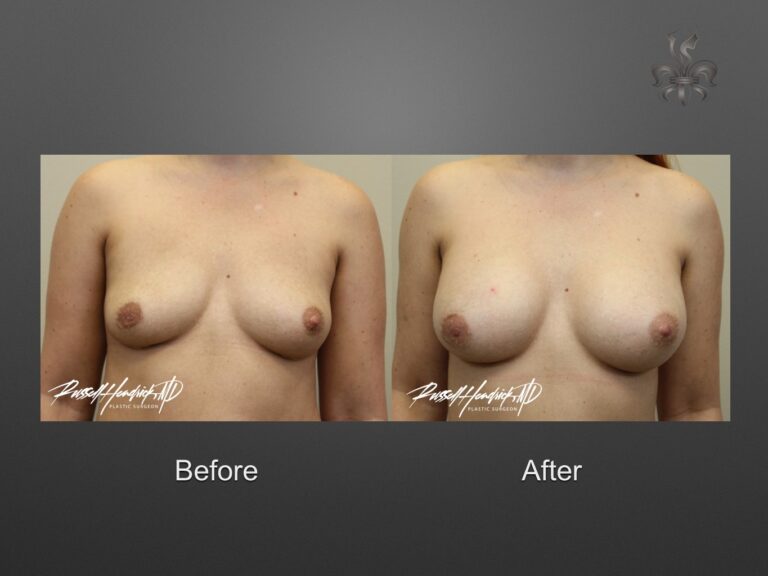 breast implant revision before and after