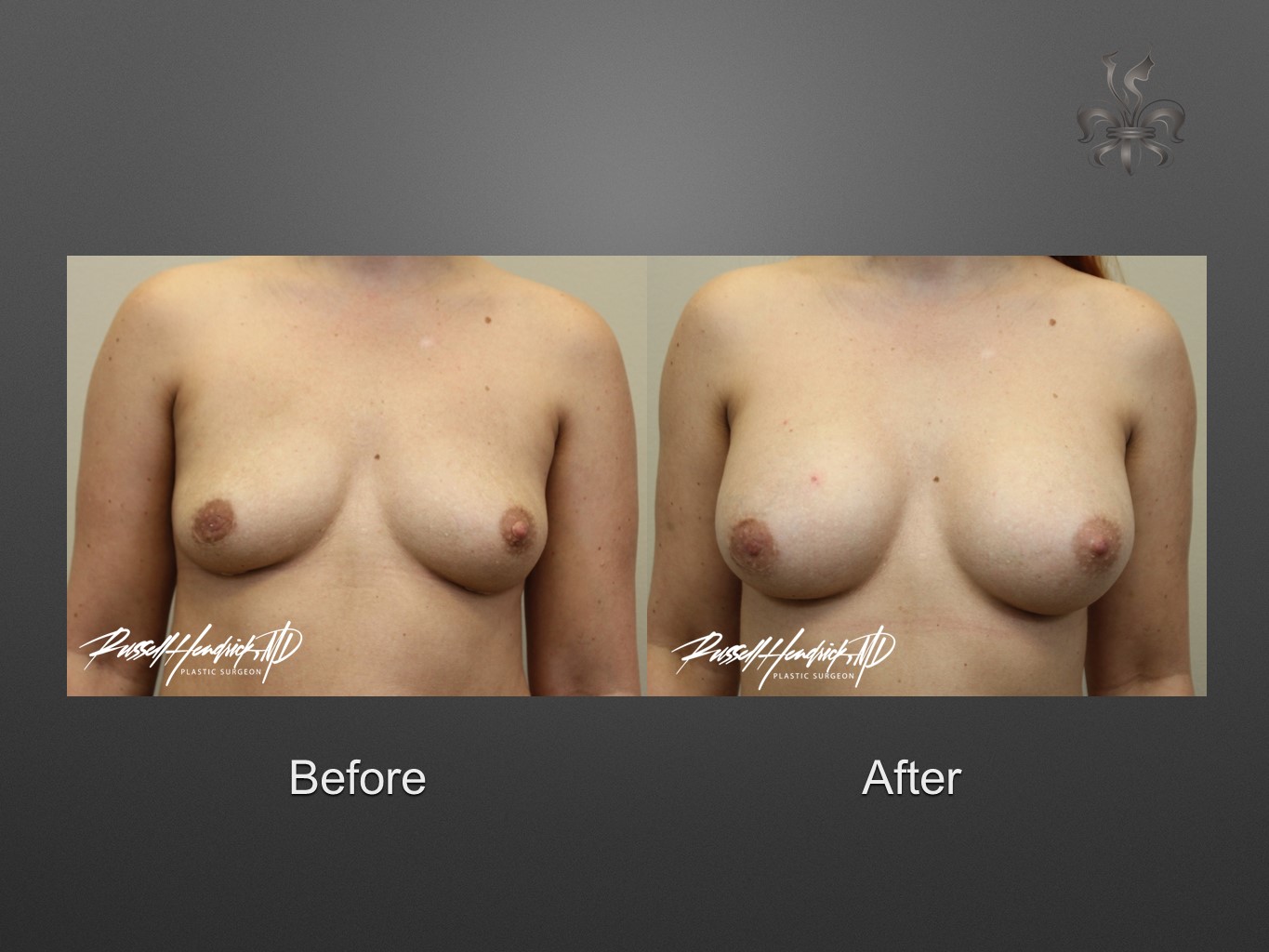 breast implant revision before and after