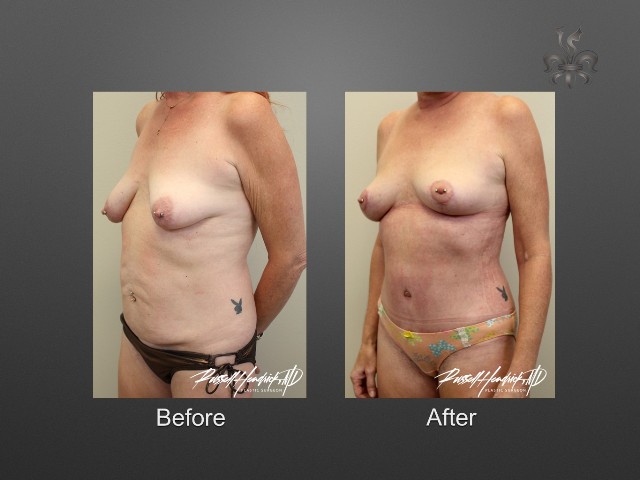 breast lift before and after