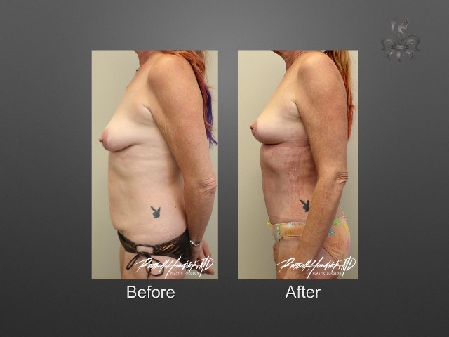 breast lift before and after