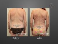 breast lift before and after