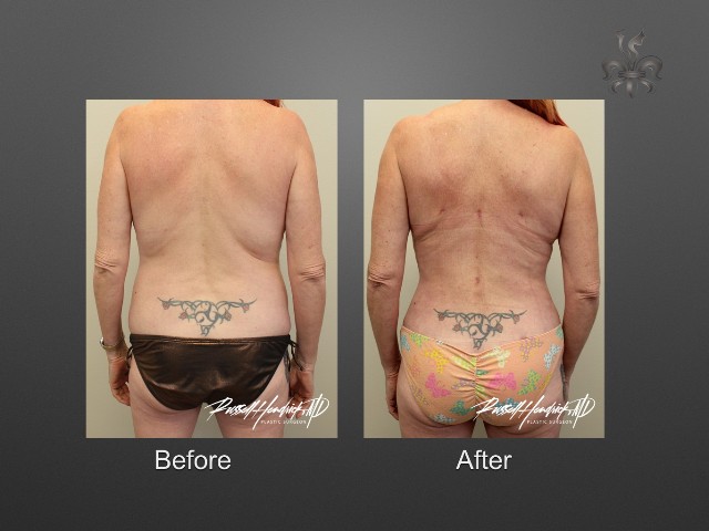 breast lift before and after