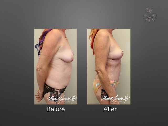 breast lift before and after