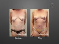 breast lift before and after