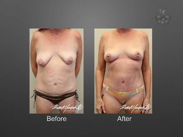 breast lift before and after