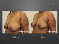 breast lift before and after