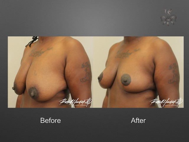 breast lift before and after