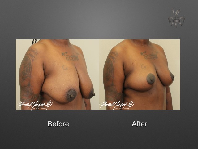 breast lift before and after