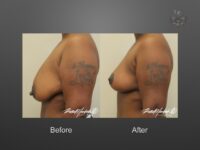 breast lift before and after