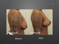 breast lift before and after
