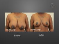 breast lift before and after