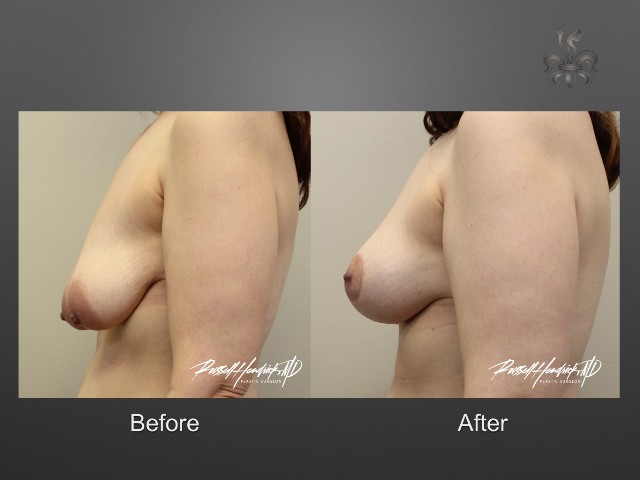 breast lift before and after