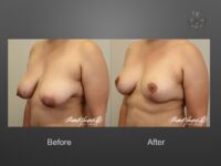 breast lift before and after