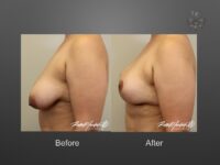 breast lift before and after