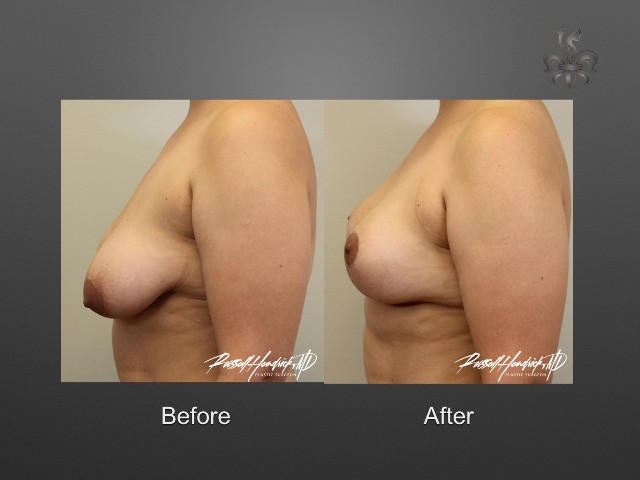 breast lift before and after