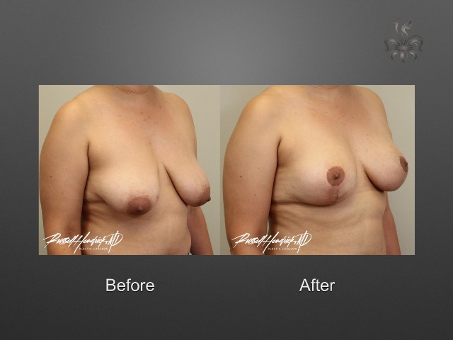 breast lift before and after