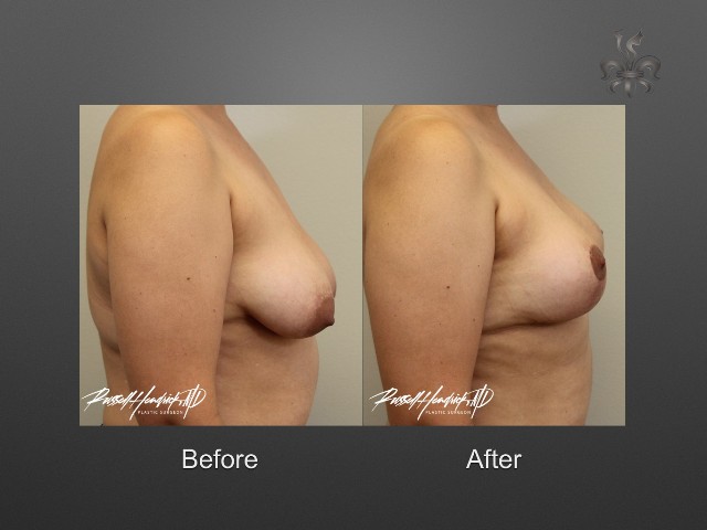 breast lift before and after