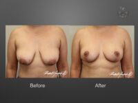 breast lift before and after