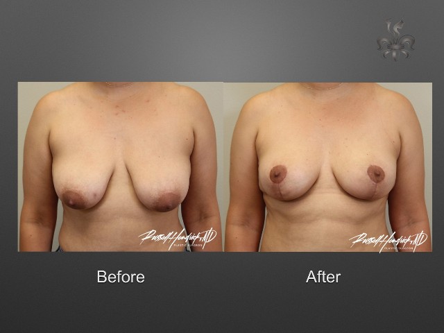 breast lift before and after