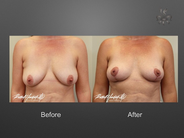 breast lift before and after