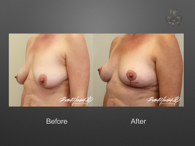 breast lift before and after