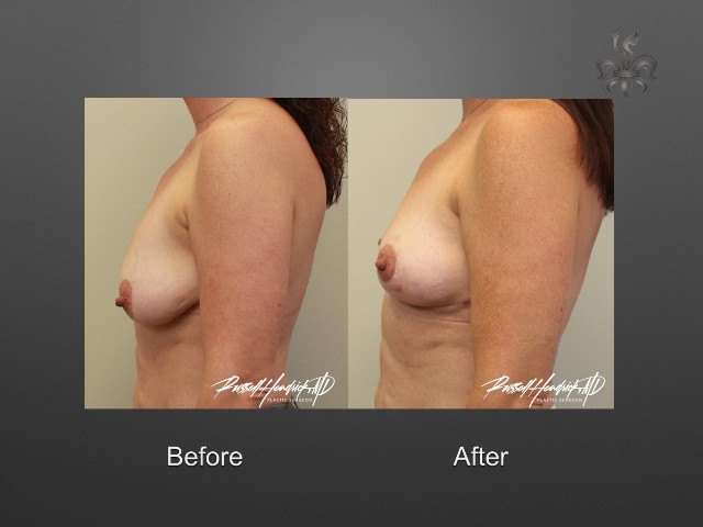 breast lift before and after