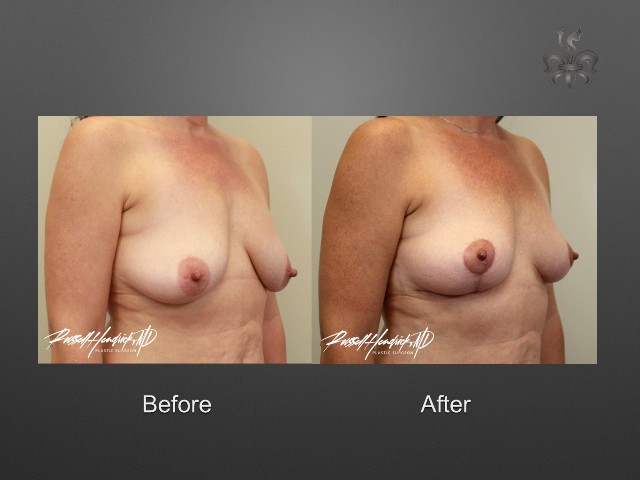 breast lift before and after