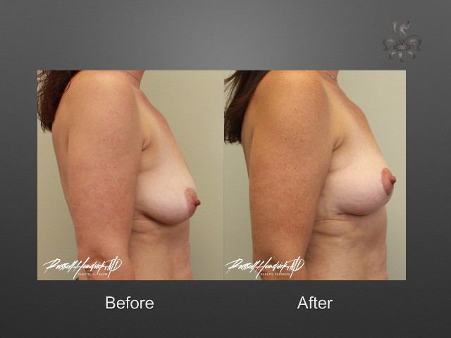 breast lift before and after