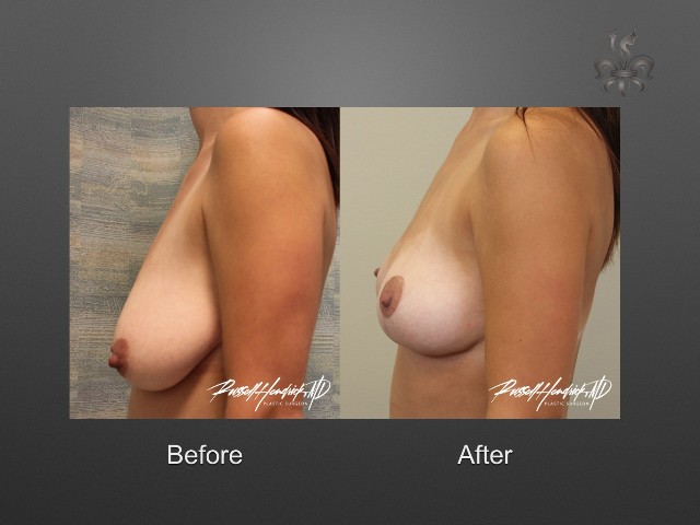 breast lift before and after