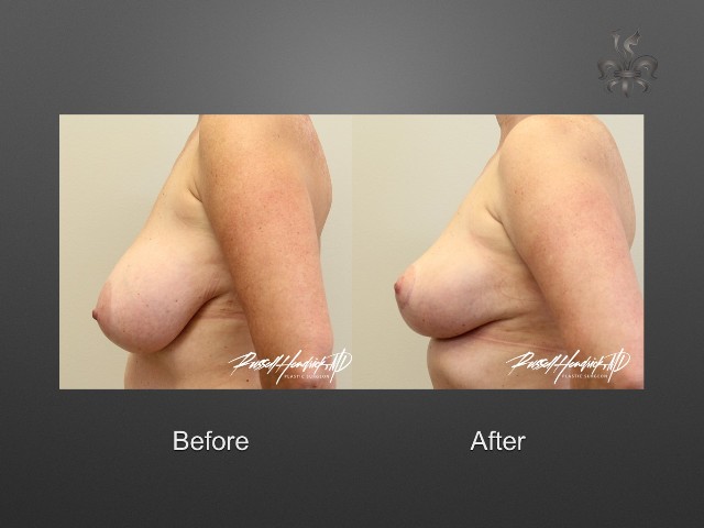 breast lift before and after